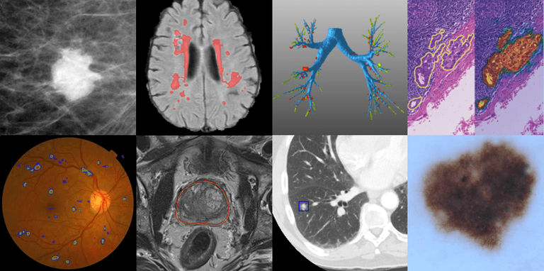 Automated tumor detection