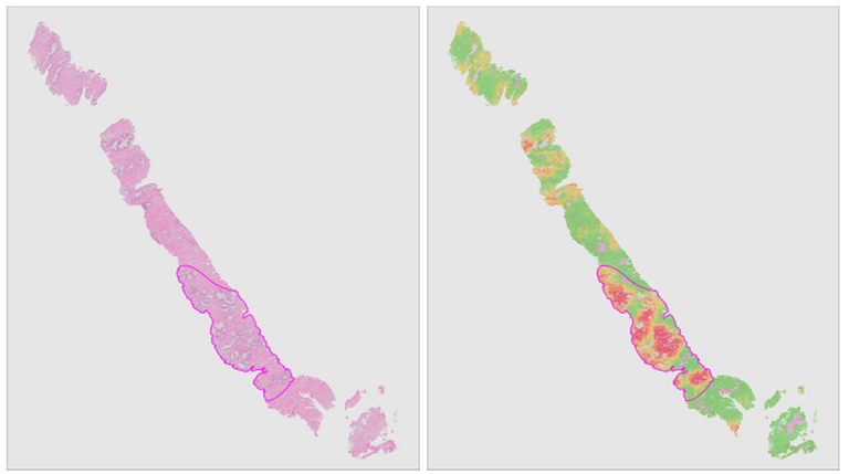 Automated tumor detection