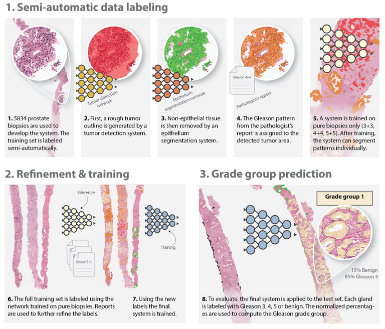 Deep learning system Gleason grading