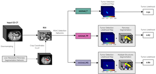 New publication on Deep Learning for Pancreatic Ductal Adenocarcinoma Detection on Computed Tomography