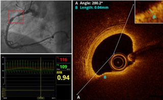 5-year results of PECTUS-obs published in EuroIntervention