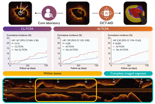 PECTUS-AI study published in European Heart Journal
