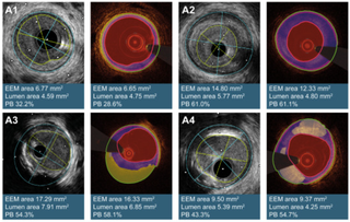 New study shows that OCT-AID can assess plaque burden on OCT