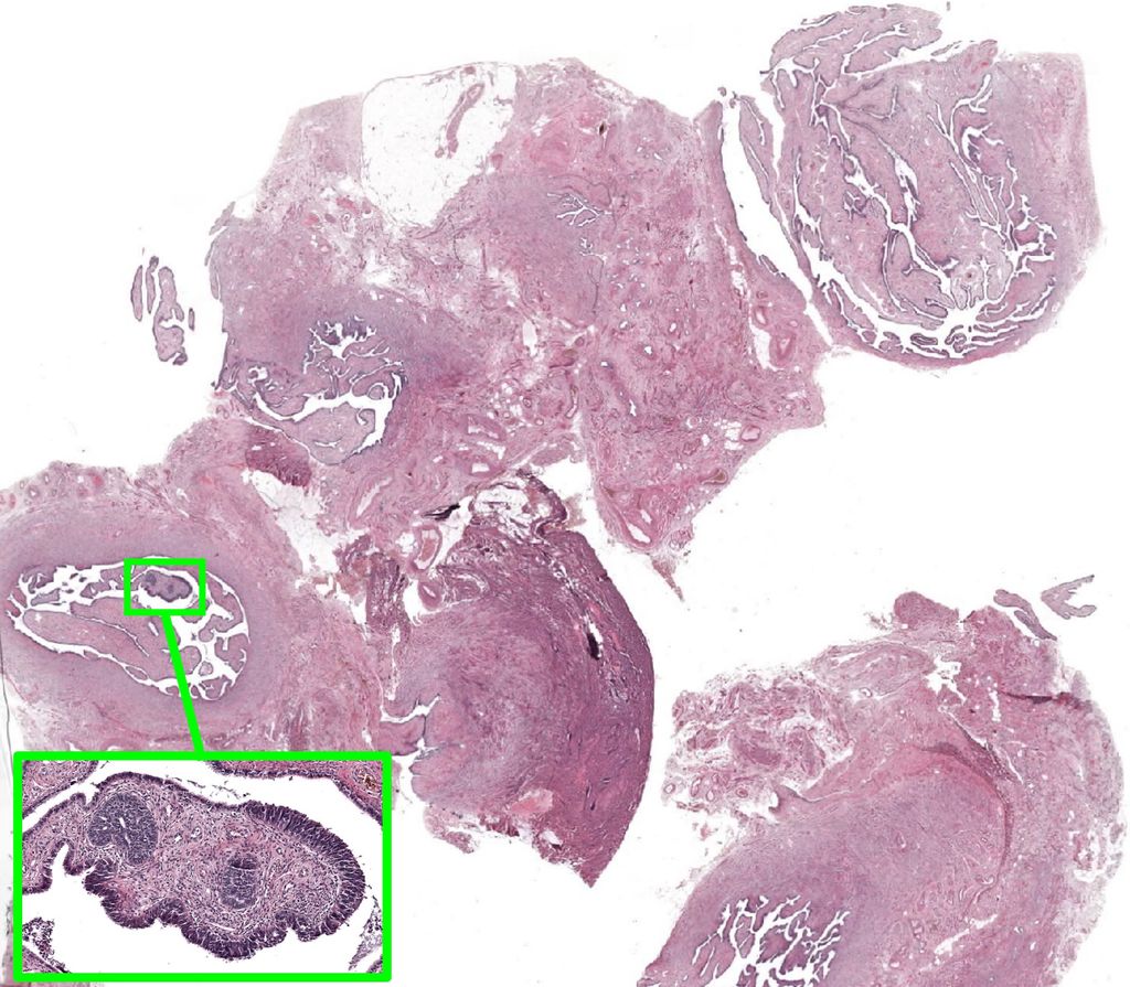 STIC lesion