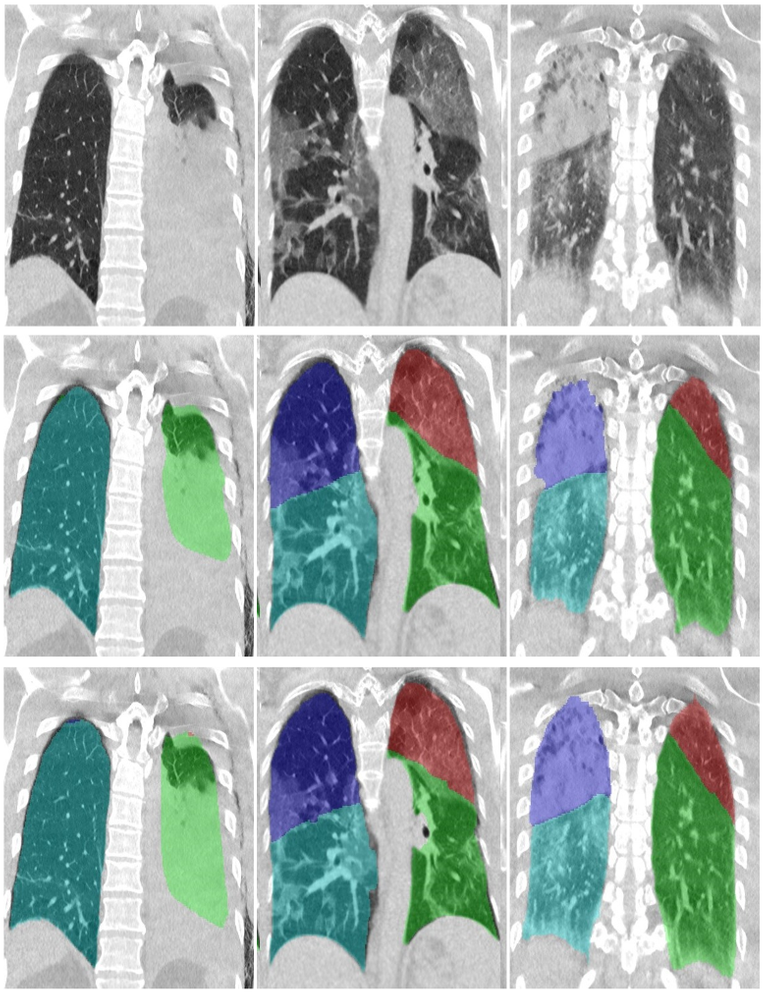 Results automated pulmonary lobe segmentation in COVID-19 patients