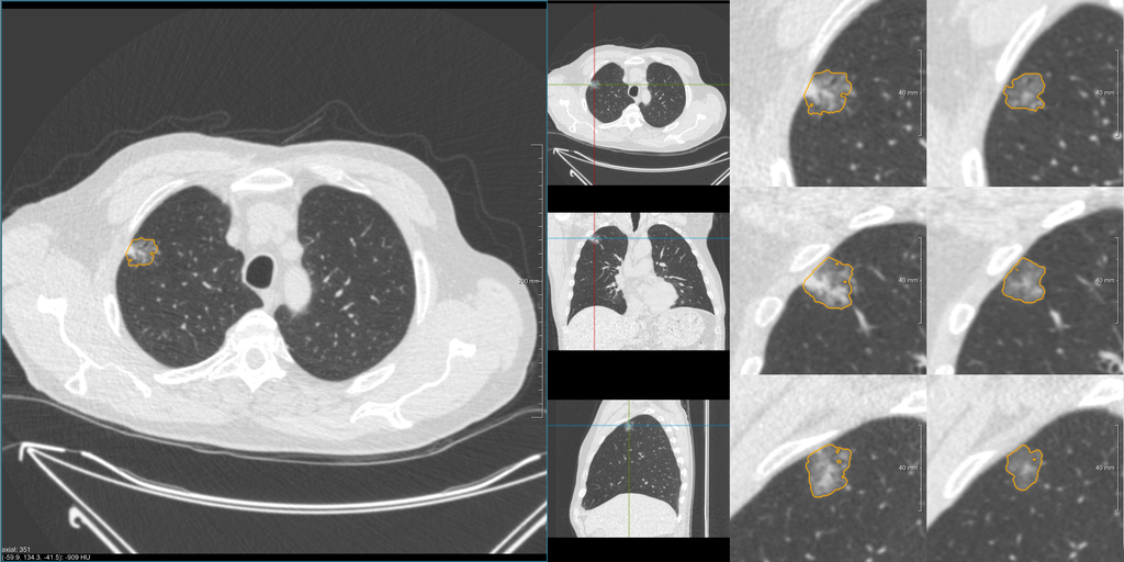 PhD candidate in MERAI Lab - Artificial intelligence for analysis of lung cancer screening CT scans