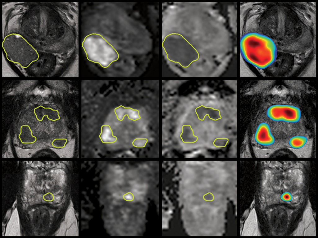 Study on End-to-end Automated 3D Prostate Cancer Detection in MRI published  in Medical Image Analysis