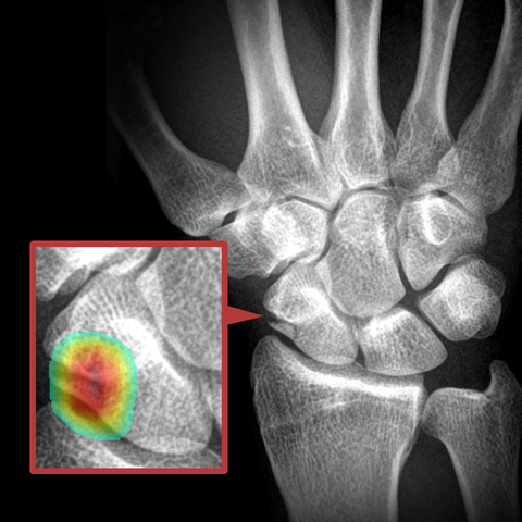 scaphoid fracture x ray