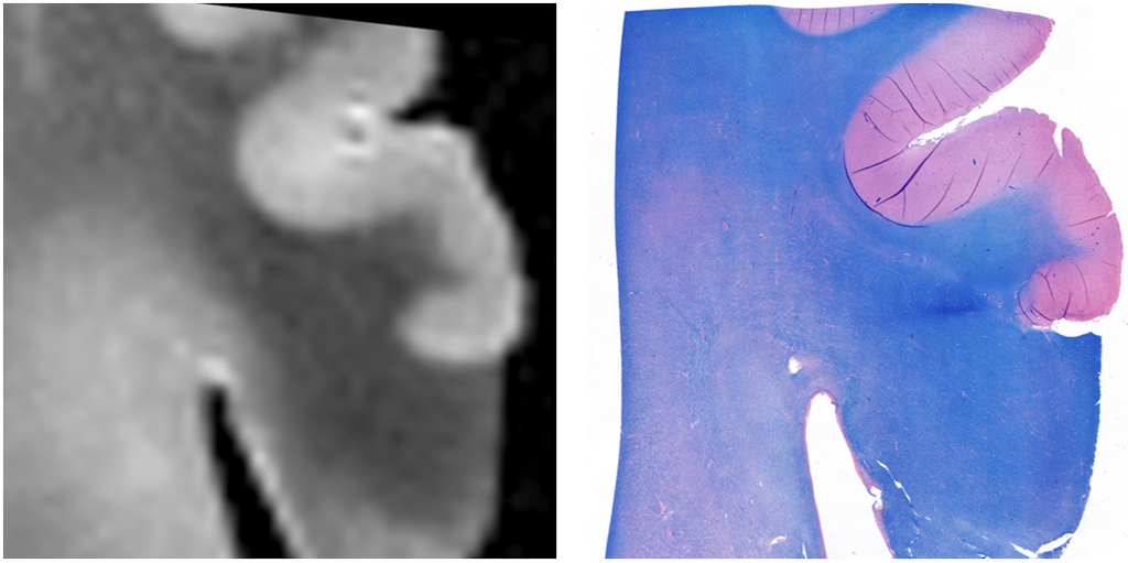 wmh-progression-detection