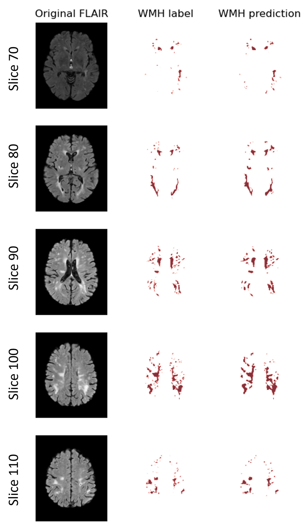 wmh-progression-detection