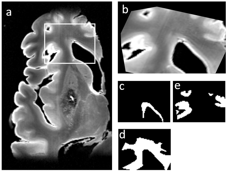 wmh-progression-detection