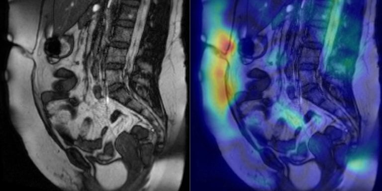 Artificial intelligence-assisted detection of adhesions on cine MRI