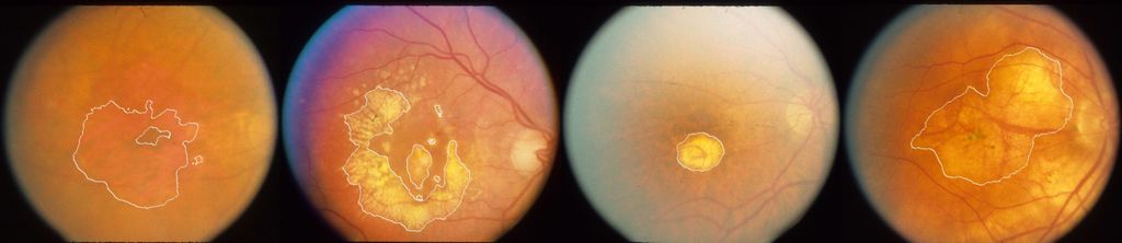 Geographic atrophy segmentation in CFI