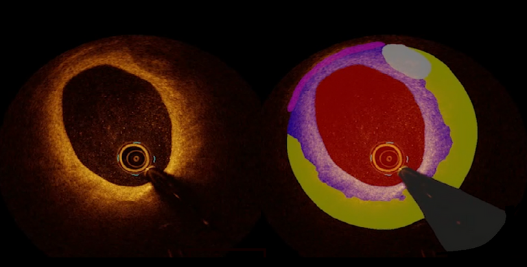 Vessel segmentation for intracoronary OCT images