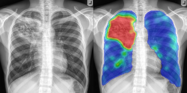 Normal Chest X Ray Vs Tb