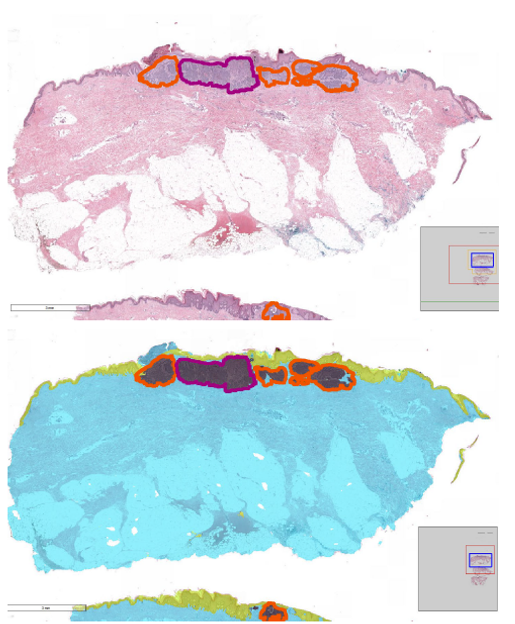 Distribution of most common tumors