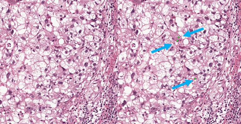 Automated Mitotic Count