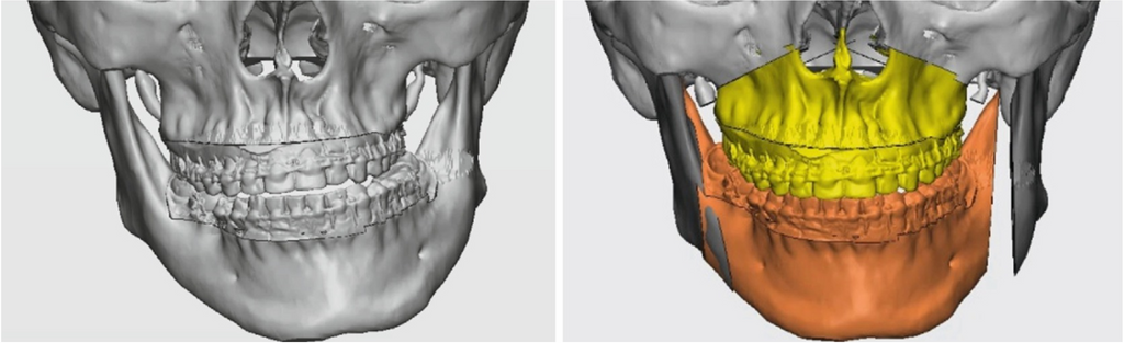 Three dimensional oral and maxillofacial surgical outcome prediction - AI  for Health