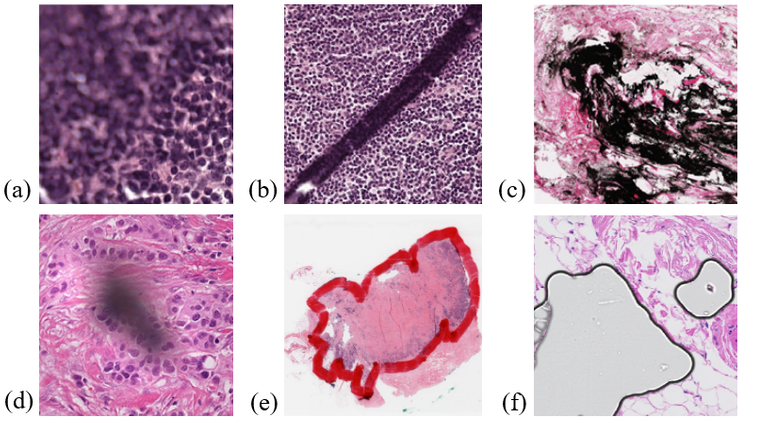 Artifact detection in digitized histopathology images - AI for Health