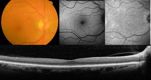 PhD position for Extraction of imaging biomarkers for AMD with Deep Learning