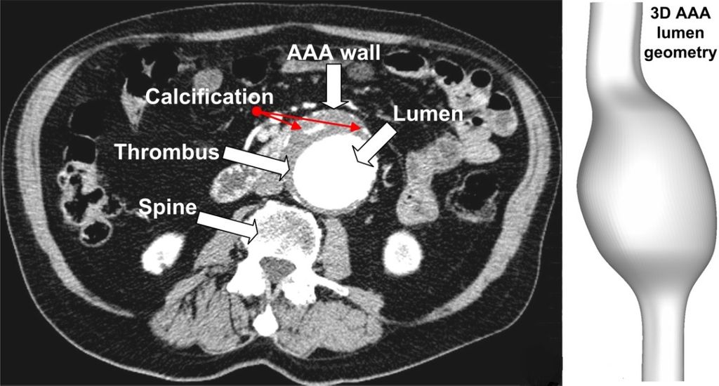 Automated AAA detection on CT scans