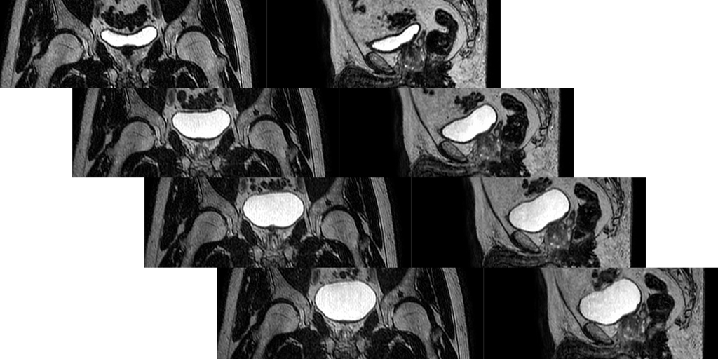 Prediction of bladder filling during radiotherapy treatment