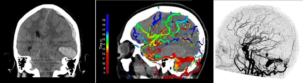 Automated detection of cranial arteriovenous shunts in 4D-CTA