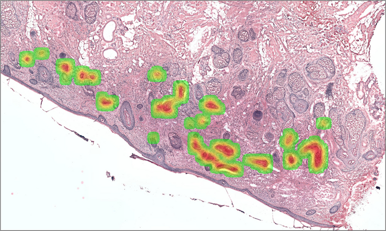 Predicting Basal Cell Carcinoma Progression from Histopathology Using Artificial Intelligence