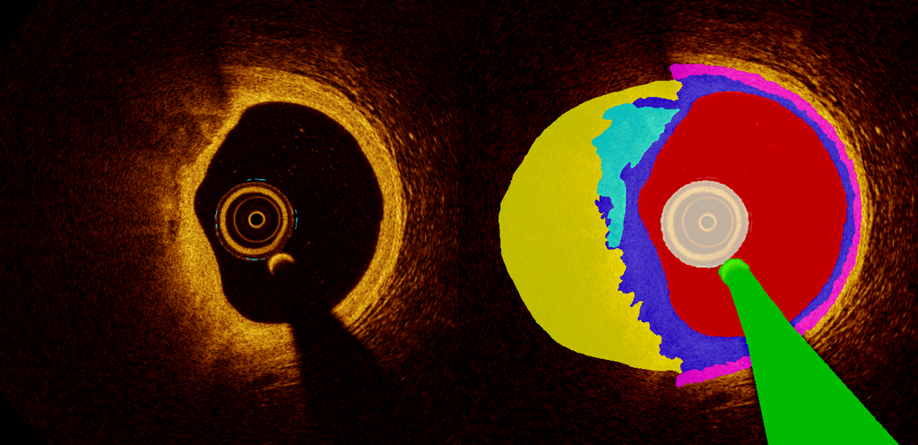 Automated analysis of intracoronary OCT images for patients with acute myocardial infarction