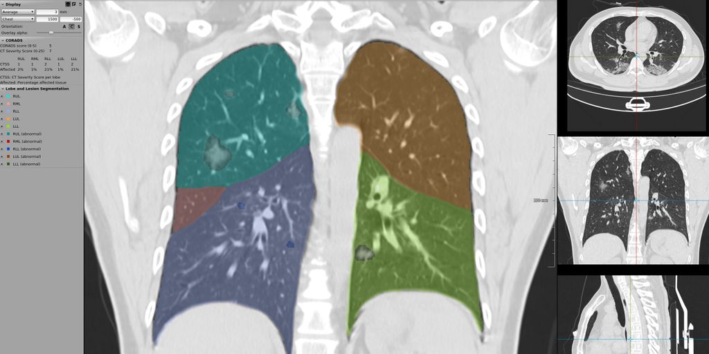 Improving detection of COVID-19 classification with CT scans