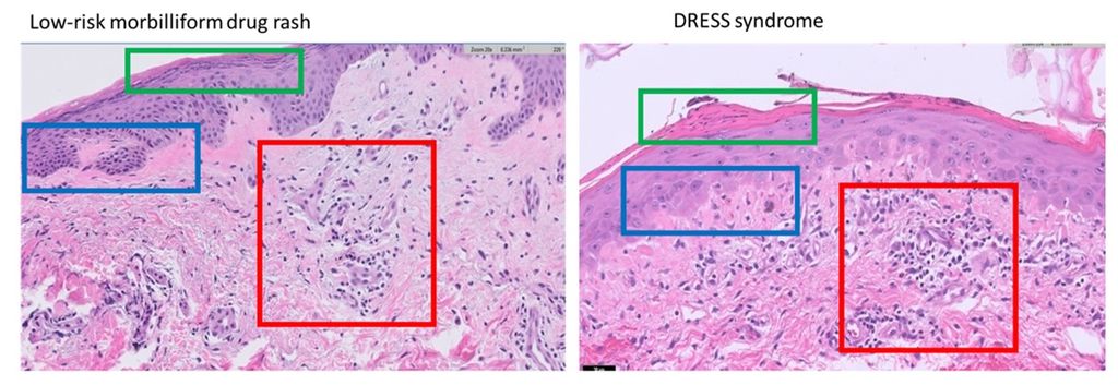 Automated detection of DRESS syndrome