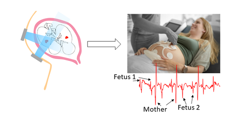 Fetal heart rate detection in twin pregnancies