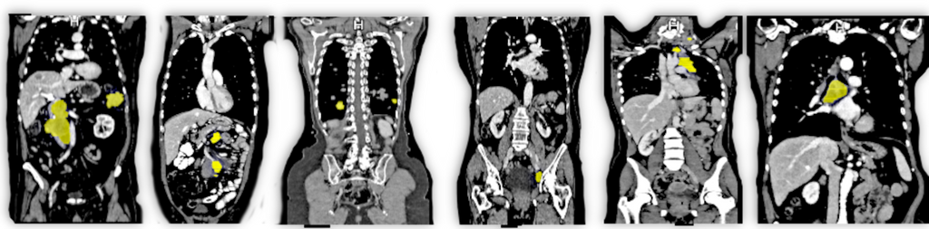 Leveraging Weak Annotations in AI-based Metastasis Detection from CT Images