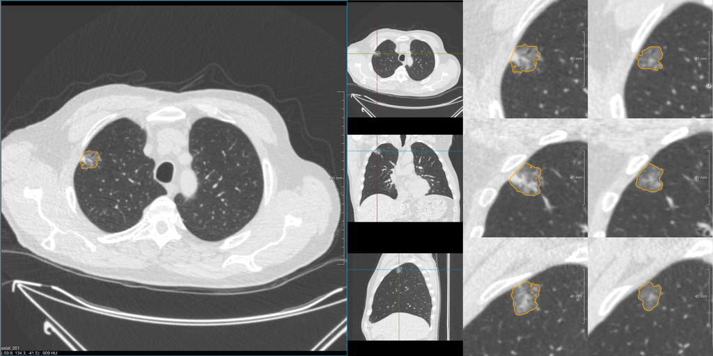 PhD position on using artificial intelligence for improving the efficiency of lung cancer screening