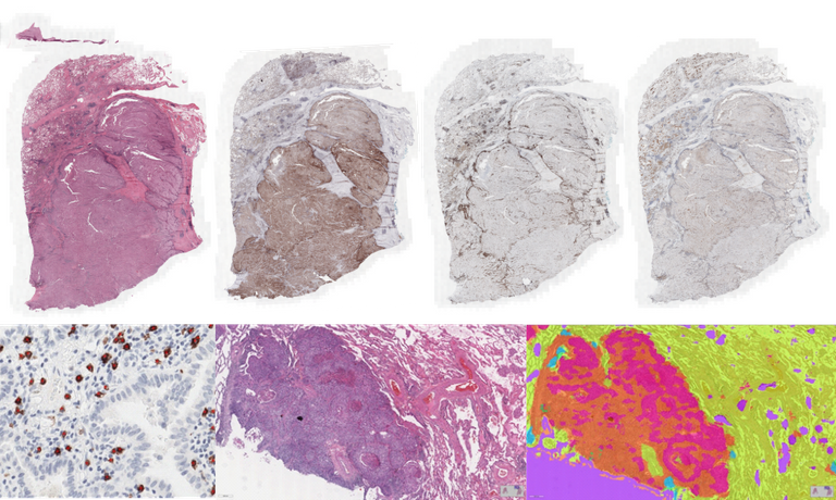 AI to analyze lung cancer histology images