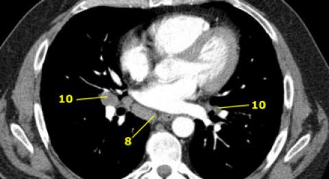 Deep learning for fully automated detection of enlarged lymph nodes in thoracic CT