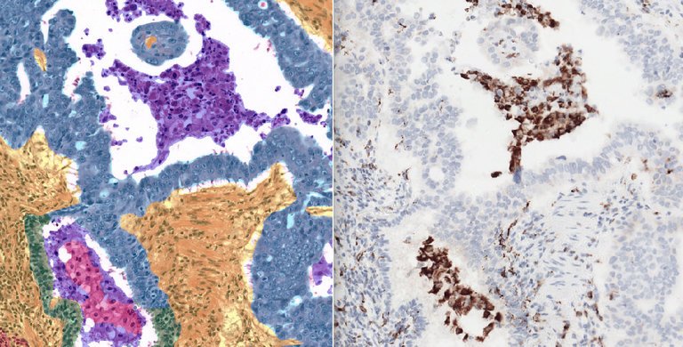 Advancing Macrophage Biomarkers for Improved Immunotherapy Response Prediction