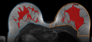 PhD candidate to assess the value of Artificial Intelligence for Breast Cancer Screening