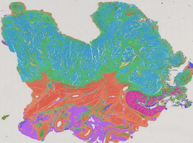 Deep Learning for the differentiation of STIC lesions