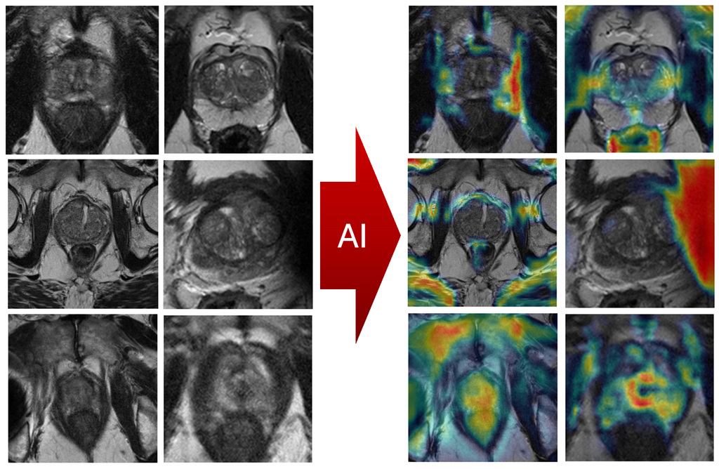 Automated AI development in Prostate Cancer