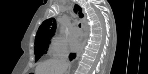 Detecting and characterizing vertebral fractures in CT scans