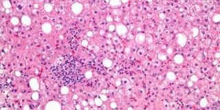 AI-based quantification of non-alcoholic steatohepatitis