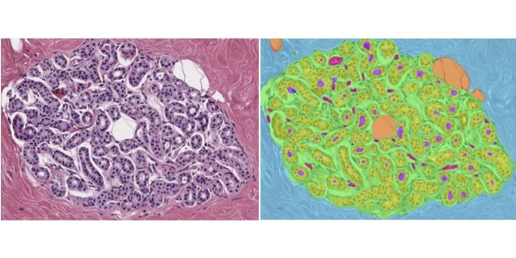 Identification of features in benign breast disease biopsies that predict breast cancer risk