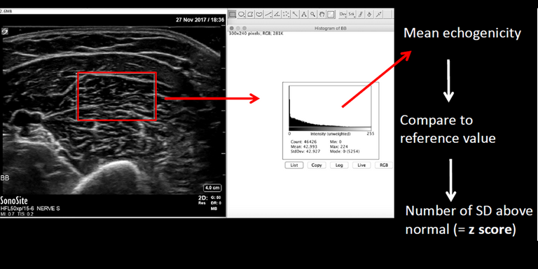 Screening for neuromuscular disorders using automatic classification of muscle ultrasound images