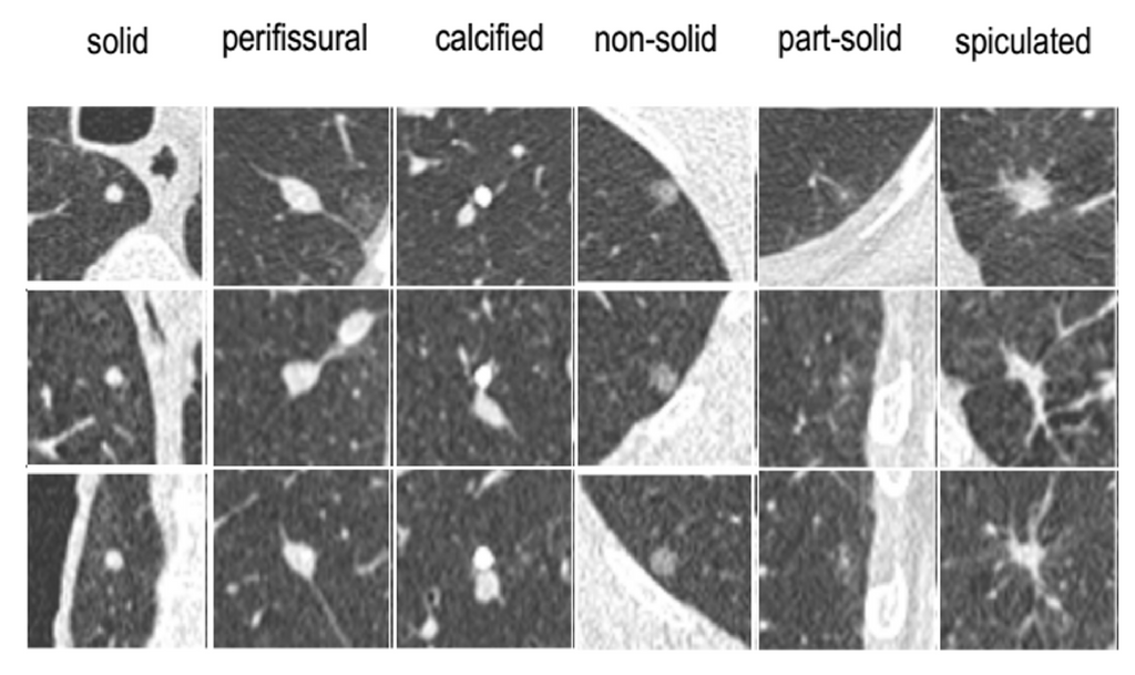 Deep learning for fully automated classification of pulmonary nodules