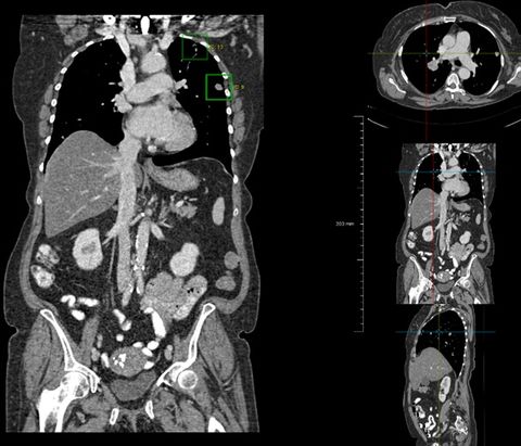 Deep learning for oncologic CT imaging