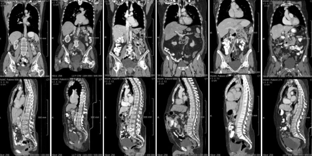 Student assistant universal lesion annotation in whole-body longitudinal CT imaging