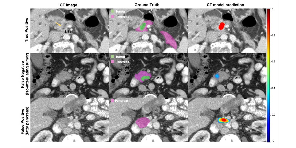 Deep learning for automatic pancreatic cancer detection on magnetic resonance images