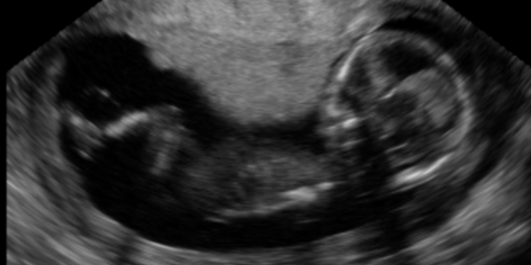 2D Plane Detection in 3D prenatal ultrasound