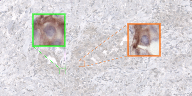 Improving PD-L1 digital pathology image analysis